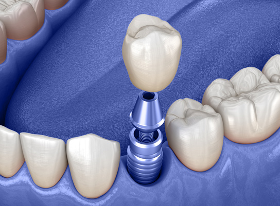 egyetlen fog potlasa implantatummal